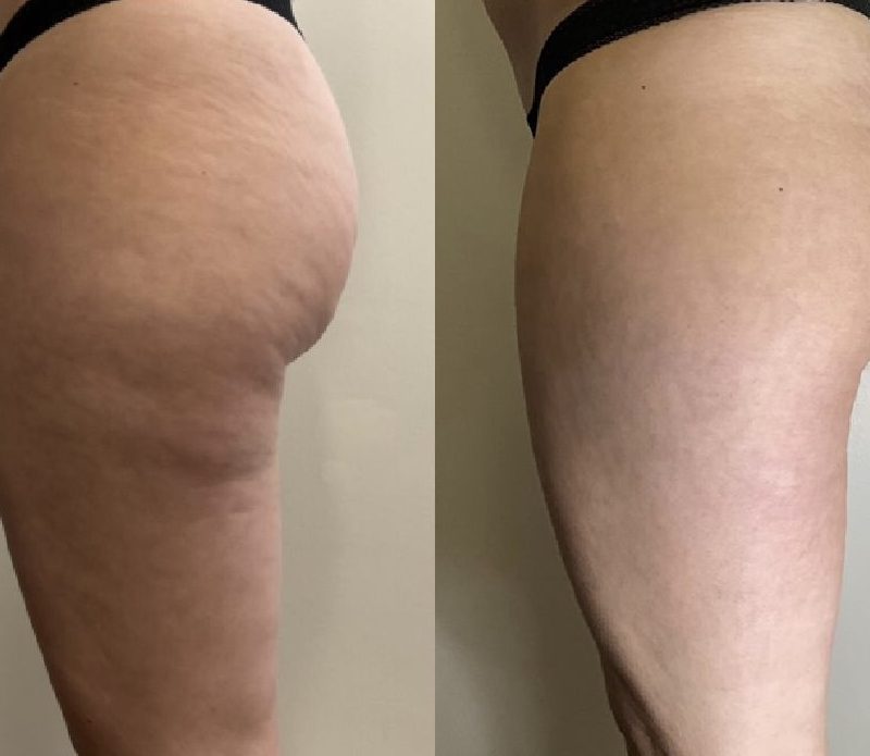 GlowVital Anti-Cellulite Massage Oil